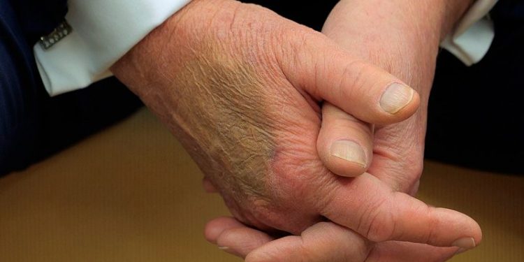 White House explains bruise on Trump’s hand seen during Macron meeting